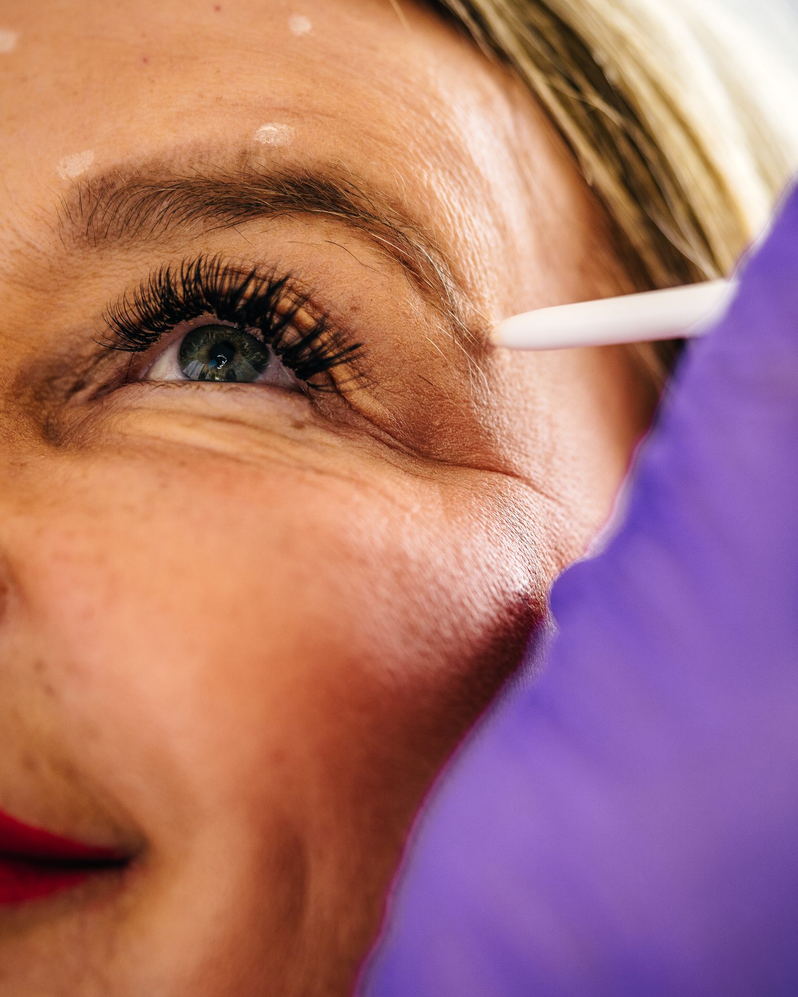 Markierung der Behandlungspunkte an den Krähenfüßen vor einer Botox-Behandlung