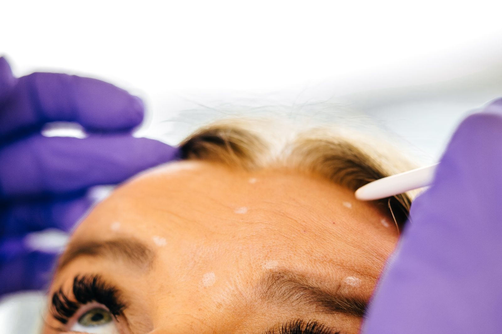 Markierung der Stirnfalten vor einer Behandlung mit Botulinumtoxin