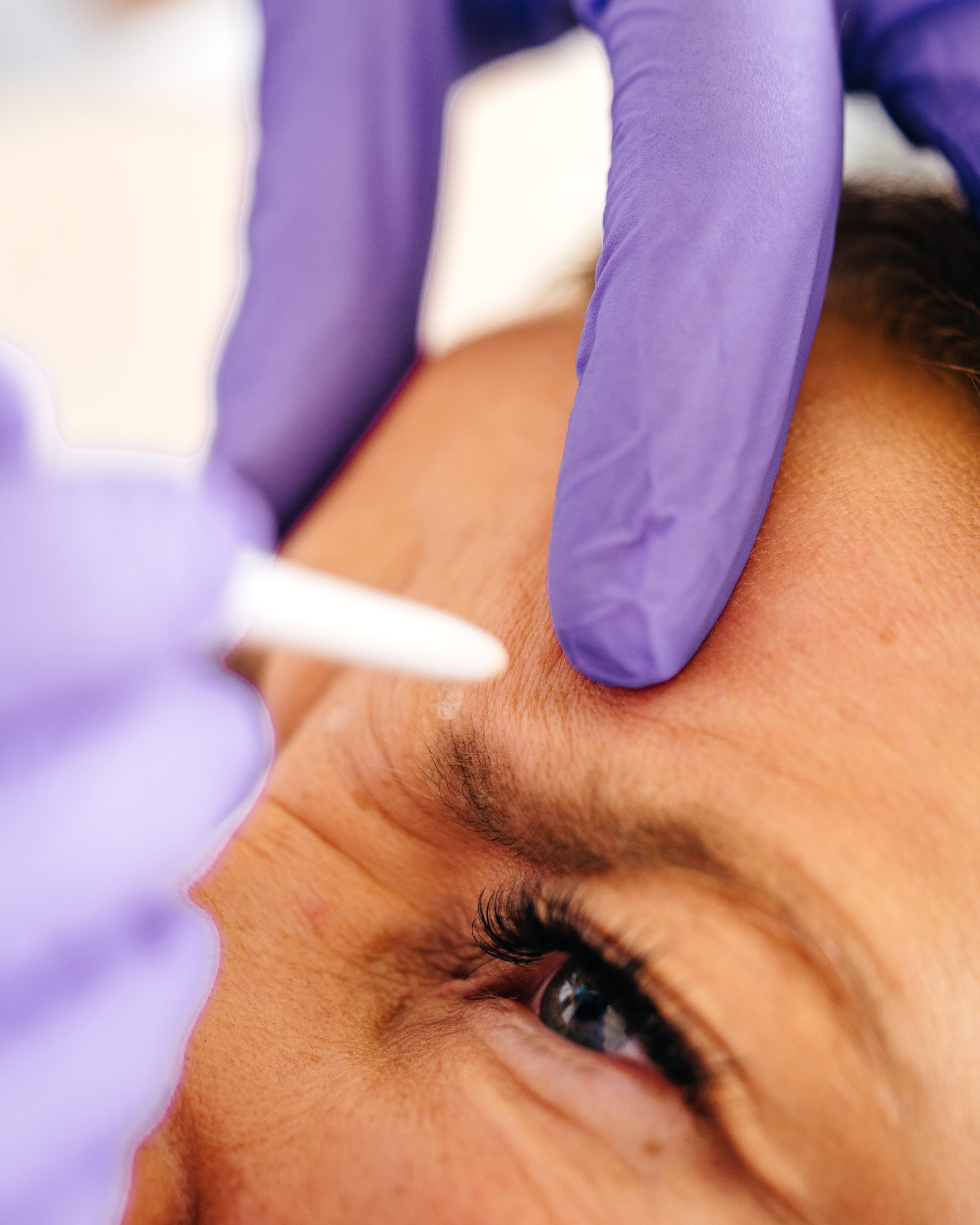 Markierung der Behandlungspunkte an der Zornesfalte vor einer Botox-Behandlung